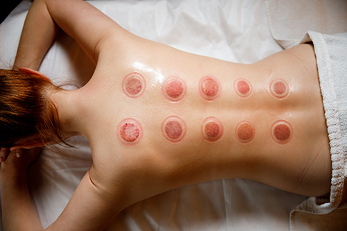 Cupping Therapy